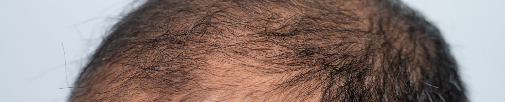 Alopecia Androgenética