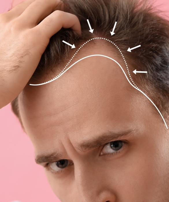 Alopecia Androgenética - Maria Clara de Paula