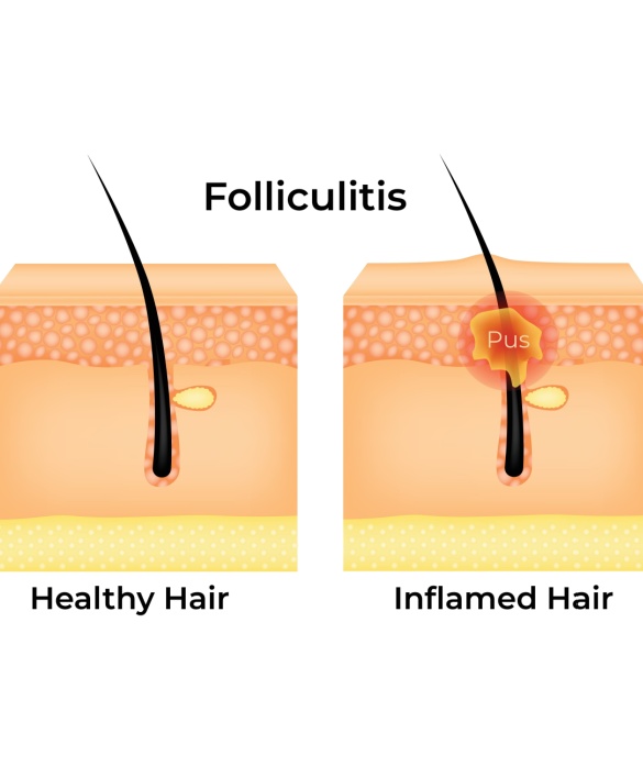 Foliculite Dissecante - Maria Clara de Paula