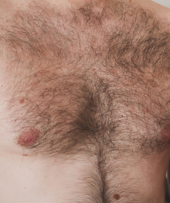 Técnica Body Hair (Uso de Pelos Corporais para Transplante Capilar) - Maria Clara de Paula
