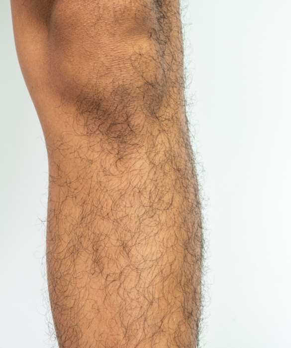 Técnica Body Hair (Uso de Pelos Corporais para Transplante Capilar) - Maria Clara de Paula
