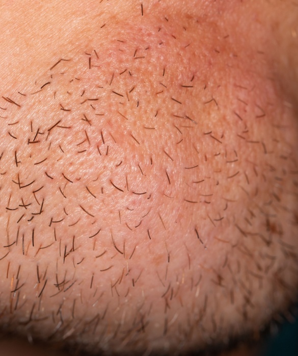 Transplante de Barba - Maria Clara de Paula