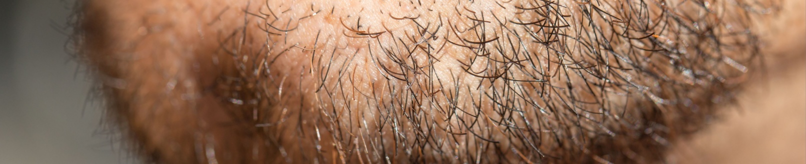 Transplante de Barba