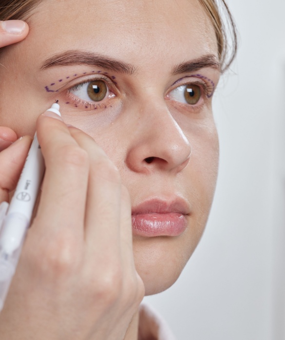 Blefaroplastia - Maria Clara de Paula